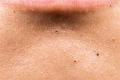 How To Get Rid Of Black Spots On Skin