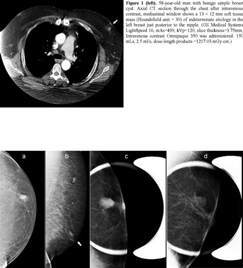 Figure 1 From Benign Breast Cyst Without Associated Gynecomastia In A
