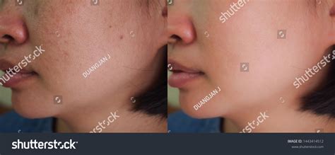 Image Before After Spot Melasma Pigmentation Foto Stock Editar Agora