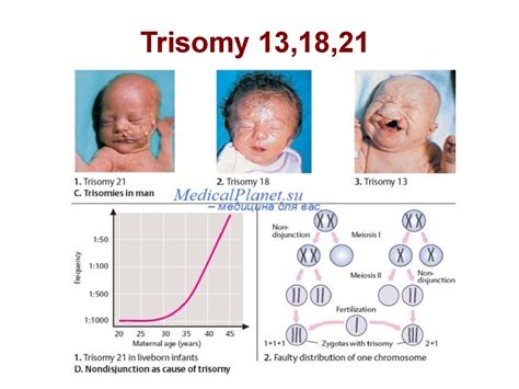 Trisomy 13trisomy 13 On Emaze