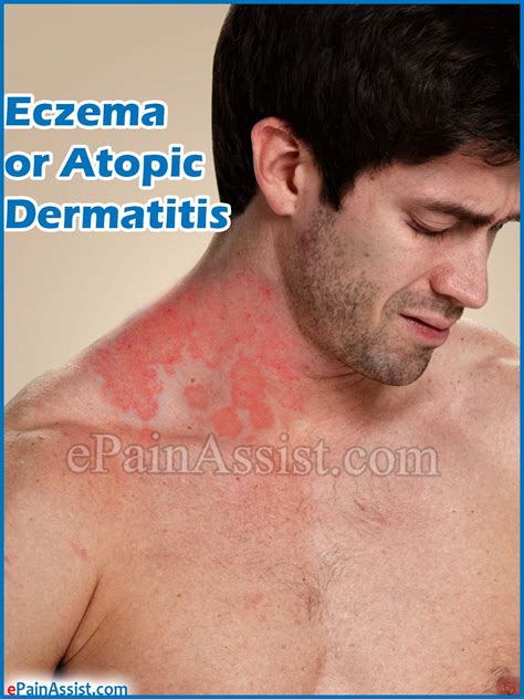 Eczema Or Atopic Dermatitiscausessymptomstreatmenthome Remedies