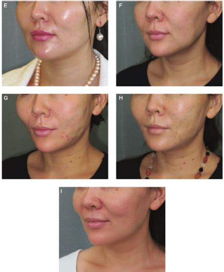Thread Lifting Procedure Complete Guide To Thread Face Lift Seoul