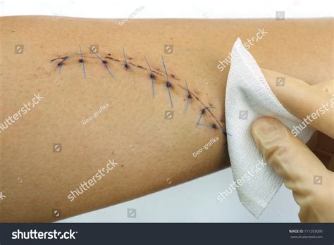 How To Clean A Wound With Stitches Gently Wash The Suture And The
