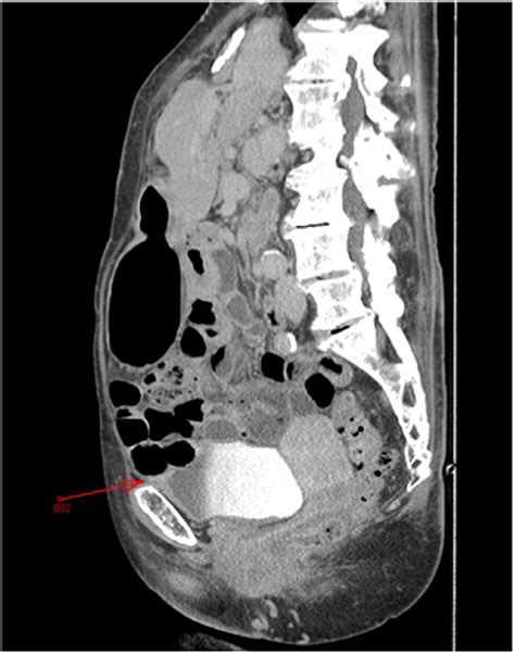 Sagittal Ct Image Of The Abdomen And Pelvis With Oral And Iv Contrast