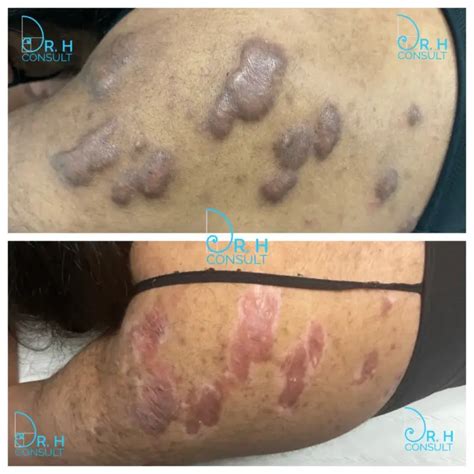 Keloid Scar Treatment Removal London Surrey Dr H Consult