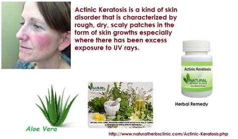 Some become malignant tumors only occasionally and only after a prolonged period of time (facultatively). Natural Treatment for Actinic Keratosis | Symptoms, Causes ...