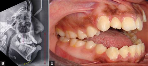 Principles Of Orthognathic Surgical Correction Of Skeletal Anterior