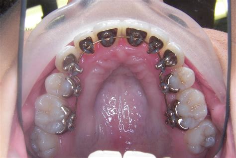 Lingual Braces Hidden Braces Chorley Orthodontics