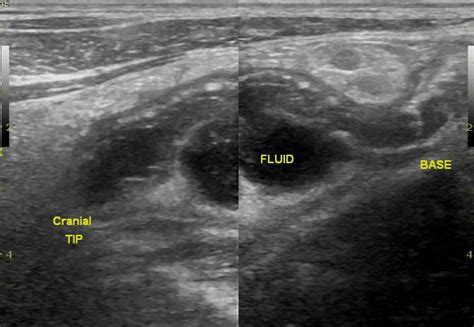 Appendicitis Ultrasound Radiopaedia Appendicitis Is Inflammation Of The