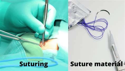 Suture Suture Basics