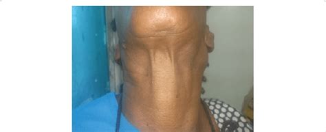 Bilateral Upper Cervical Lymph Nodes Enlargement Download Scientific