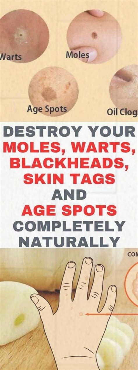 Wash them till they fill clean. How To Get Rid Of Warts, Moles, Age Spots And Skin Tag ...