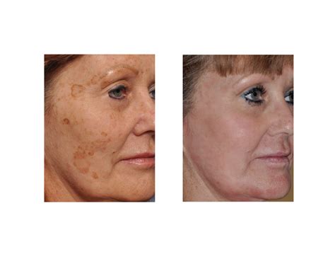 Laser Treatment For Brown Spots On Face