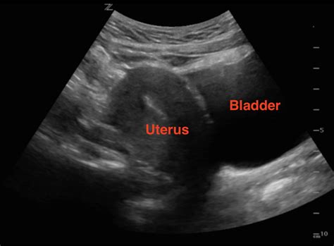 Sagittal Uterus Ultrasound