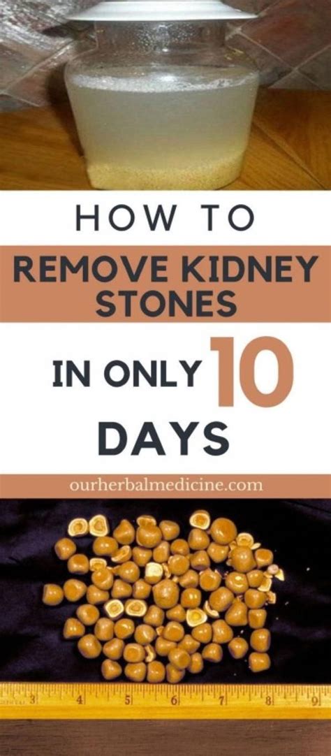 Home Remedies For Kidney Stones Remedies Natural Remedies