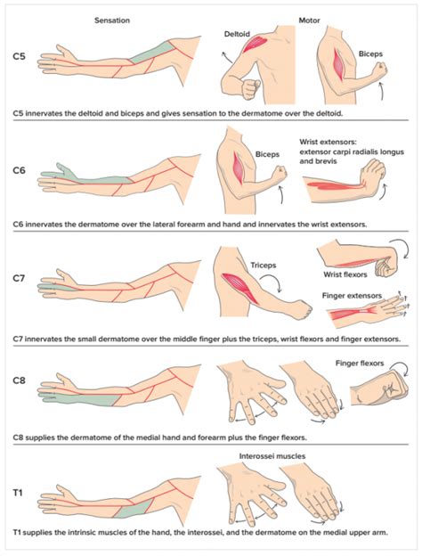 Cervical Radiculopathy Physiopedia