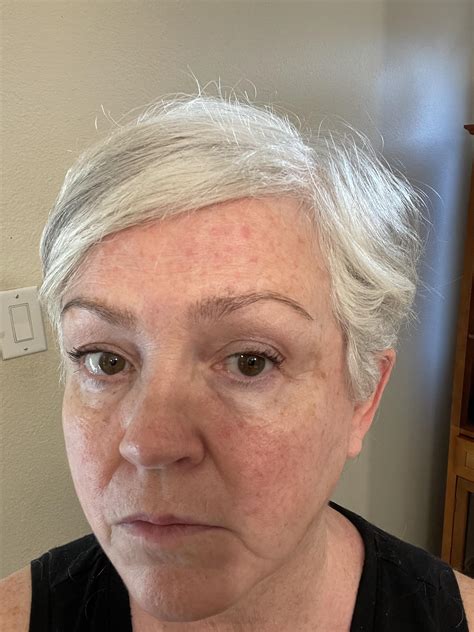 62 year old female woke up today with flat red spots all over my face they don t itch r medical