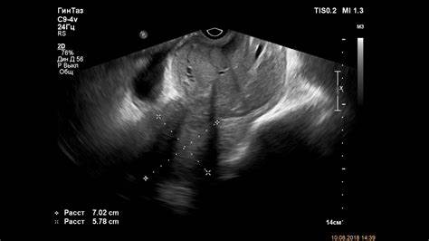 Диета рак шейки матки Рак шейки матки - YouTube Рак шейки матки - YouTube Диета рак шейки матки