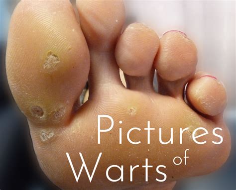 My Experience With Warts Causes Home Treatments And Pictures