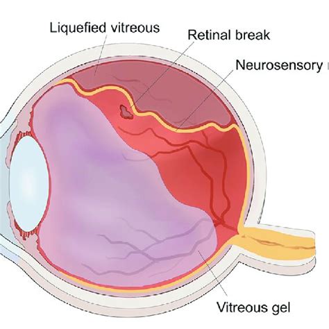 The Schematic Diagram Of Rhegmatogenous Retinal Detachment The