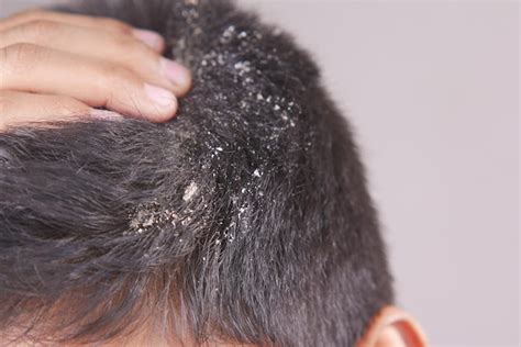 Premium Photo Men With Dandruff In His Hair Closeup