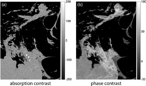 Direct Comparison Of Absorption And Phase Contrast Breast Ct
