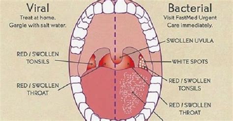 Sore Throat Causes Symptoms And Remedies How To Relief Viral