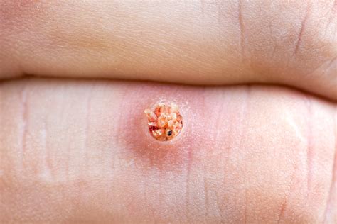 Warts On Kids Are They Contagious Their Causes Treatment