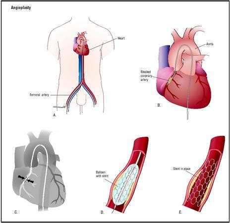 To calculate each city's price index value, we start by assigning a value of 100 to a central reference city (that happens to be prague). How much will it cost for a complete angioplasty procedure ...