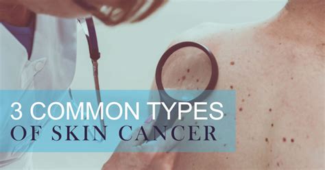 Common Types Of Skin Cancer Bardmoor Cancer Center