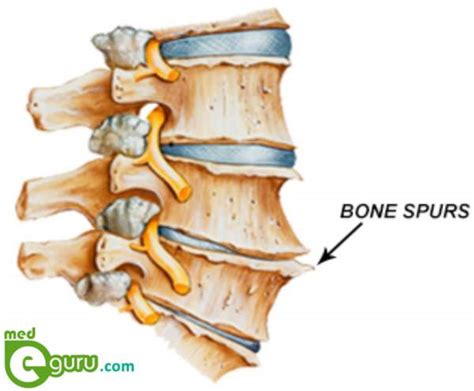 What Is A Bone Spur Bone Spurs Treatmentmed E Guru