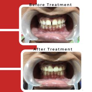 Luckily, there are other ways to straighten your teeth without getting braces fitted; How to fix Gap in Front Teeth without Braces | Jussmile Dental Clinic Chennai
