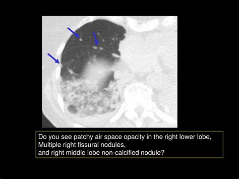 Ppt Image Gallery Lesion Detection On Low Dose Chest Ct Powerpoint