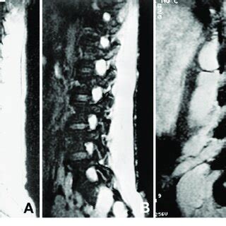 A Sagittal T Weighted Magnetic Resonance Mr Image Displaying The