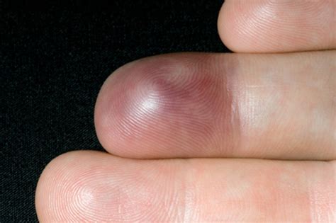An Unusual Finger Injury The Bmj