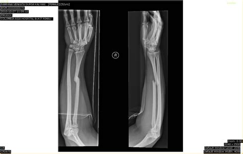 Forearm Single Bone Fracture The Orthopedics Malaysia Blog