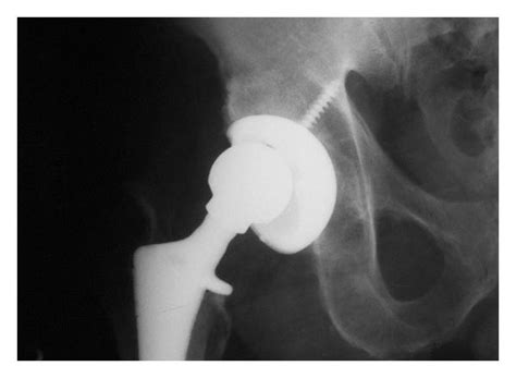 Anterior Subluxation After Total Hip Replacement Confirmed By