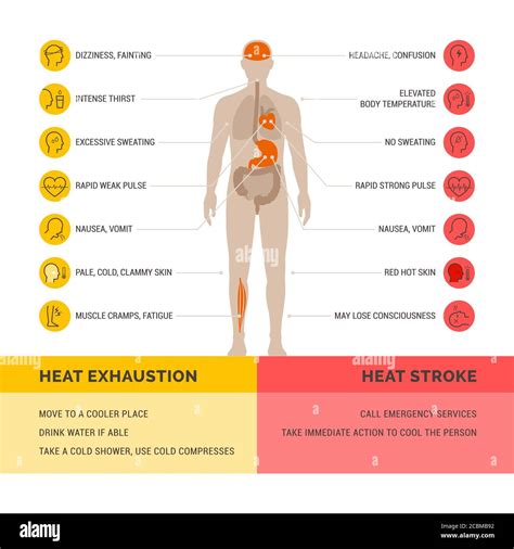 Heat Exhaustion And Heat Stroke Healthcare Infographic Symptoms And