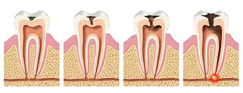 What Are Dental Caries Century Smile Dental