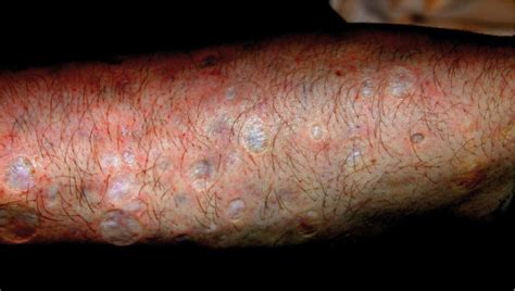 Skin Popping Scars A Telltale Sign Of Past And Present Subcutaneous