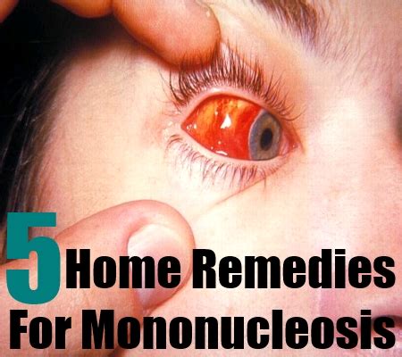 Some patients amoxicillin rash is common to girls than boys. Five Home Remedies For Mononucleosis - Natural Home ...
