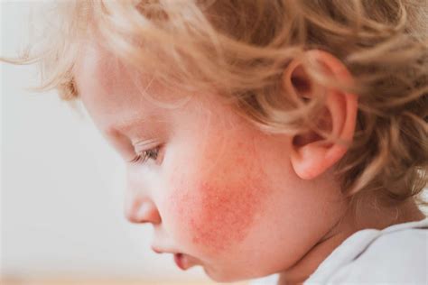 Managing Your Childs Eczema A Psychodermatologist Explains The