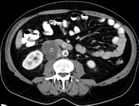 Infected Retroperitoneal Cystic Lymphangioma A Case Report Eurorad