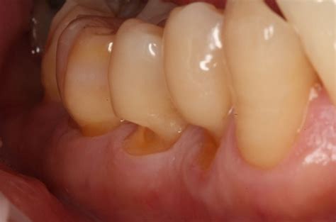 Teeth Chipping Away At Gum Line Teethwalls