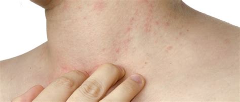Red Spots On Skin Due To Stress Milltain