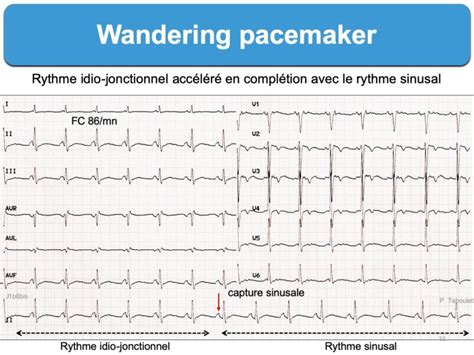 Wandering Pacemaker E Cardiogram