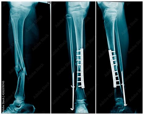 X Ray Leg Fracture With Post Operation Internal Fixation Tibia Bone