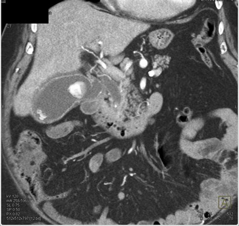 Obstructing Stone In Distal Cbd With Mirizzi Syndrome Liver Case