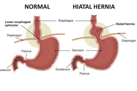 What Is A Hiatal Hernia Types Symptoms Causes Diagnosis And