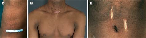 Cutaneous Features Of Crouzon Syndrome With Acanthosis Nigricans